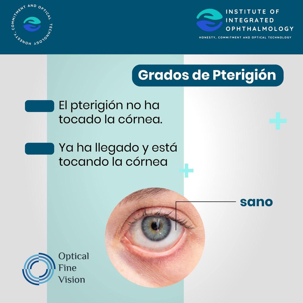 Grados de pterigión: cuando aún no toca la córnea y cuando ya la está tocando