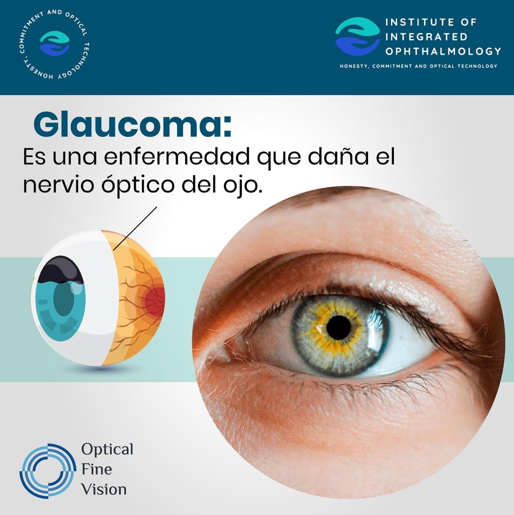 Ilustración del glaucoma como enfermedad que daña el nervio óptico del ojo