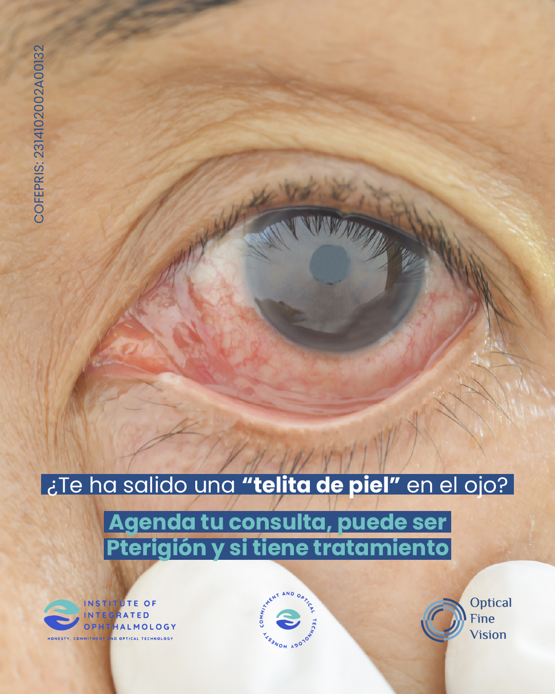 Ojo con pterigión durante la exploración oftalmológica