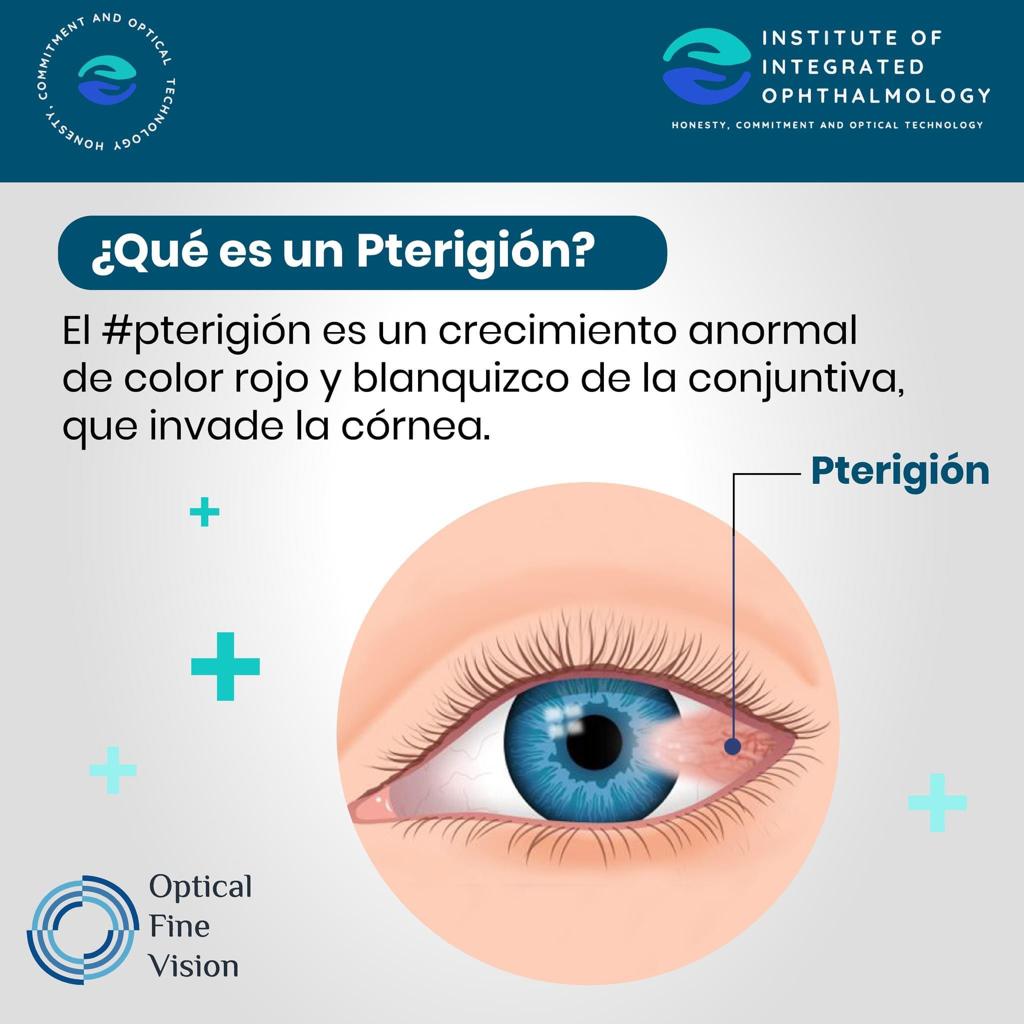 Esquema de un ojo con pterigión: crecimiento de la conjuntiva que invade la córnea