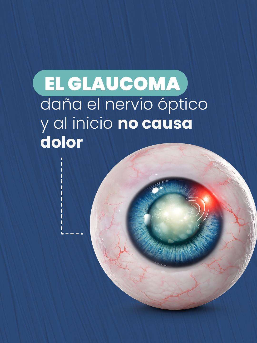 El glaucoma daña el nervio óptico y al inicio no causa dolor
