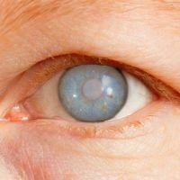 glaucoma