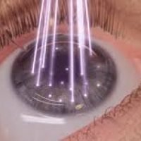 refractiva